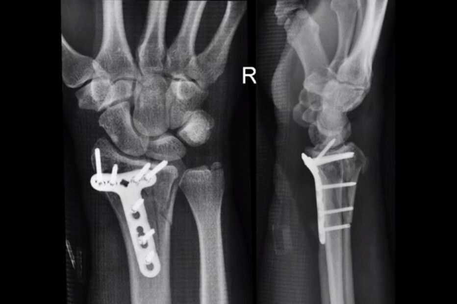 Piloto esquece-se de prender passageiro de Asa Delta e este voa pendurado mais de dois minutos	
