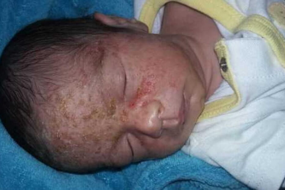 Bebé recém-nascido contrai herpes após ser beijado por visita