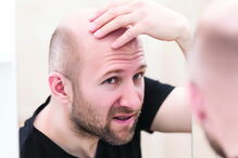 Queda de cabelo é um problema que afeta sobretudo os homens