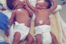 Gémeas prematuras separadas à nascença abraçam-se pela primeira vez