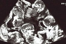 Mulher tem gravidez histórica e torna-se mãe de cinco crianças