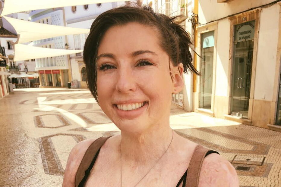 Mulher com 96% do corpo queimado após acidente de autocarro torna-se modelo