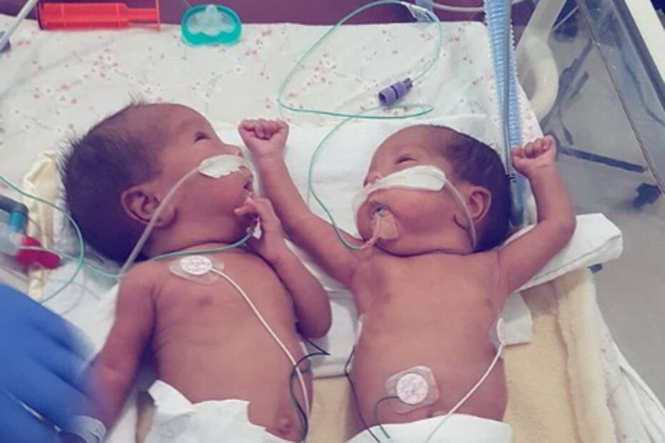 Gémeas prematuras separadas à nascença abraçam-se pela primeira vez