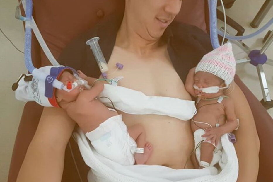 Gémeas prematuras separadas à nascença abraçam-se pela primeira vez