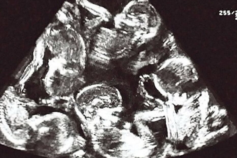 Mulher tem gravidez histórica e torna-se mãe de cinco crianças