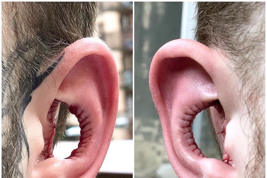 Cortar pedaço da orelha é a nova 'tendência' da Internet