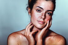 Sinais na pele deverão merecer especial cuidado. Atente a modificações de sinais já existentes