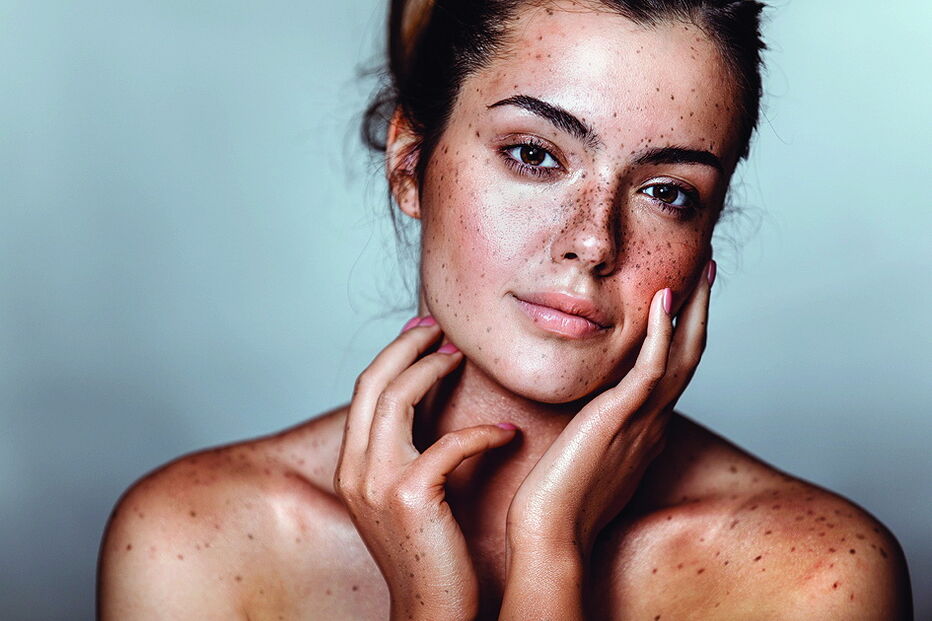 Sinais na pele deverão merecer especial cuidado. Atente a modificações de sinais já existentes