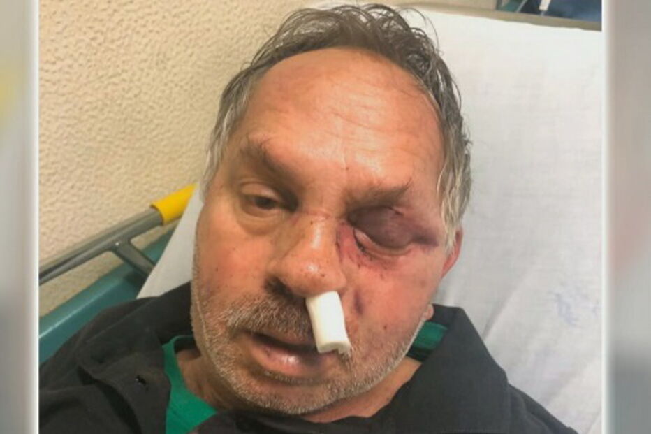 Proprietário de café espancado durante assalto em Almada
