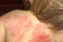 Mãe vai buscar a filha à creche e encontra-a com 25 marcas de mordidelas