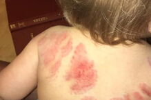 Mãe vai buscar a filha à creche e encontra-a com 25 marcas de mordidelas