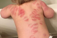 Mãe vai buscar a filha à creche e encontra-a com 25 marcas de mordidelas