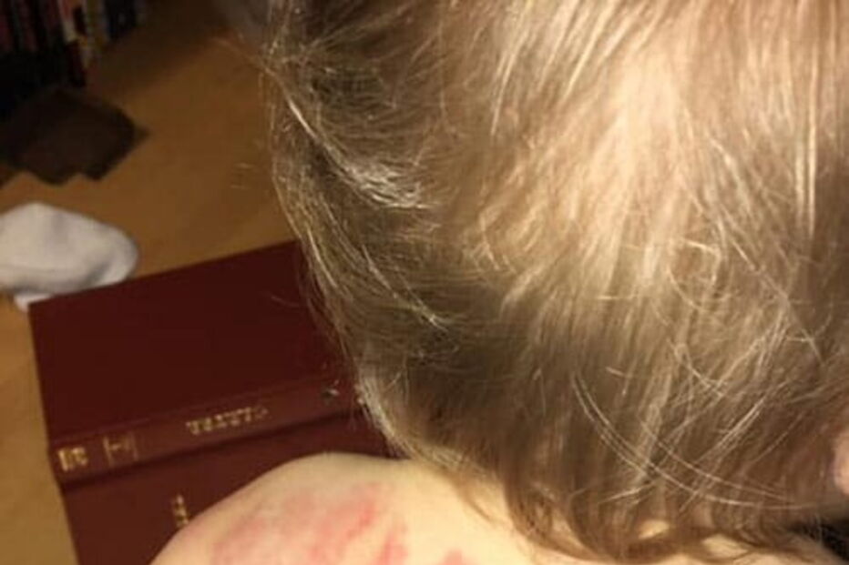 Mãe vai buscar a filha à creche e encontra-a com 25 marcas de mordidelas