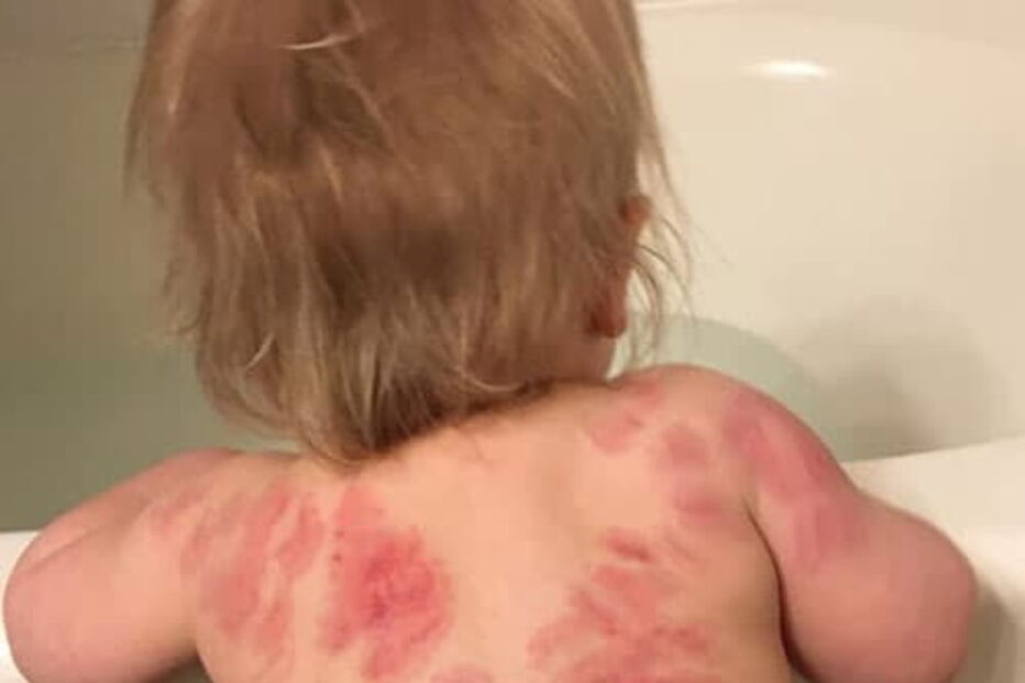Mãe vai buscar a filha à creche e encontra-a com 25 marcas de mordidelas