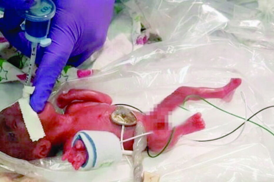 Bebé nasceu com 23 semanas e 3 dias devido a complicações na gravidez 