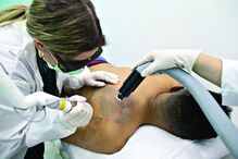 Eliminação da tatuagem acontece de forma gradual com o tratamento a laser 