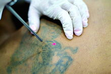 Eliminação da tatuagem acontece de forma gradual com o tratamento a laser 
