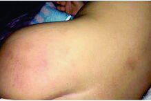 Quando despiu o filho em casa, a queixosa viu mais hematomas no corpo 