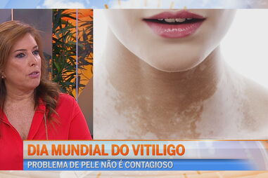 Conheça os sintomas do vitiligo