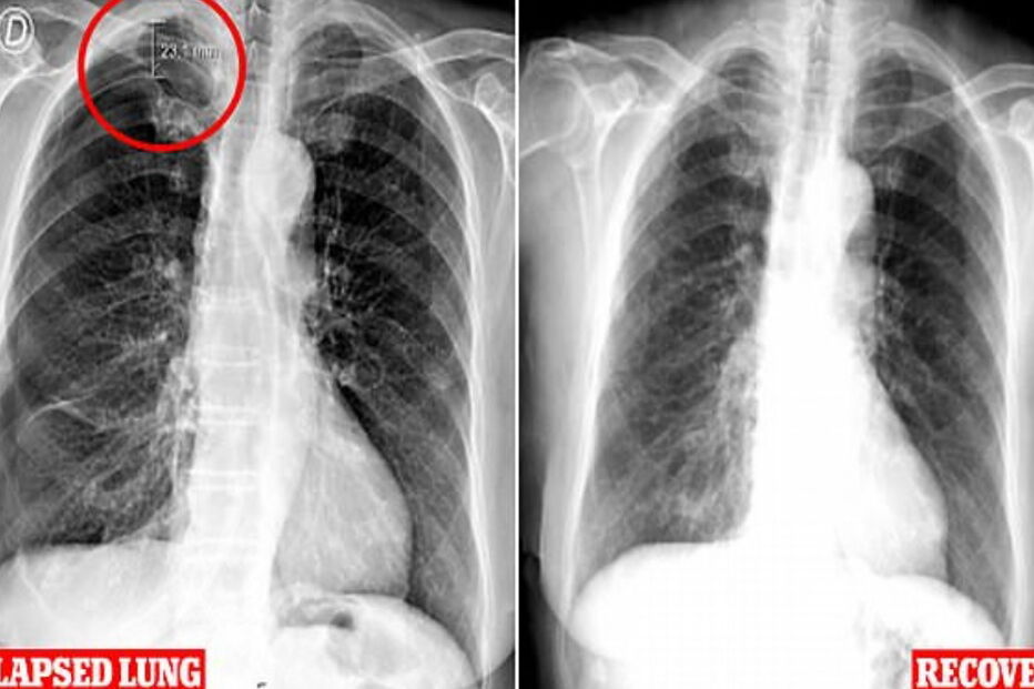 Pulmão de mulher de 79 anos entra em colapso após fazer acupuntura