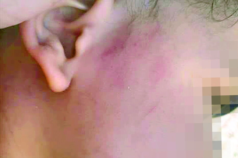 Bebé apresenta diversas marcas de agressão na cara