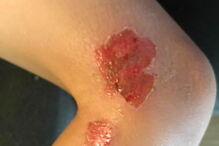 Lesões provocadas por Vibrio vulnificus