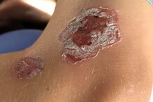 Lesões provocadas por Vibrio vulnificus