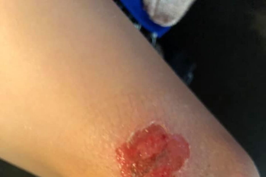 Lesões provocadas por Vibrio vulnificus