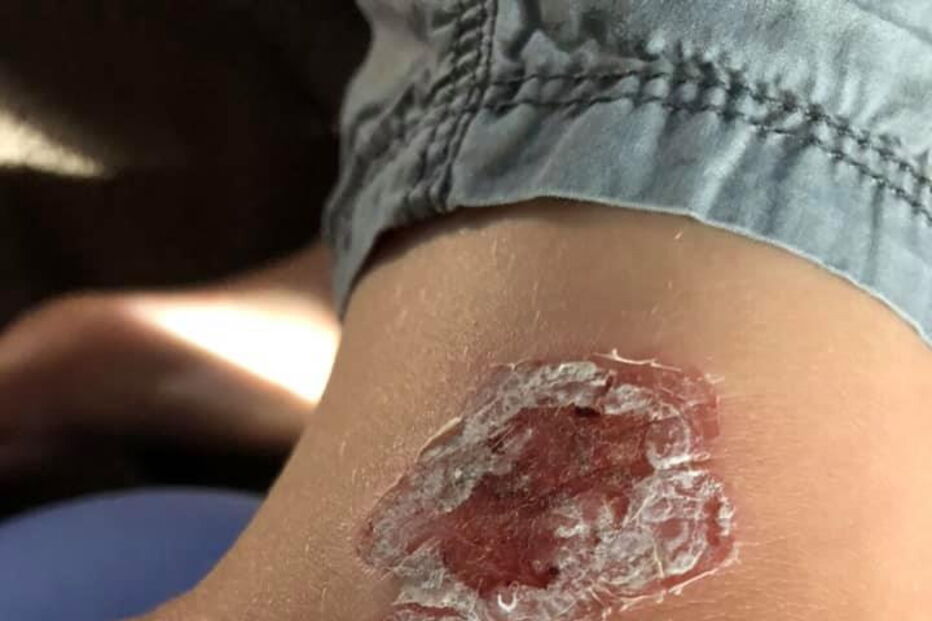 Lesões provocadas por Vibrio vulnificus