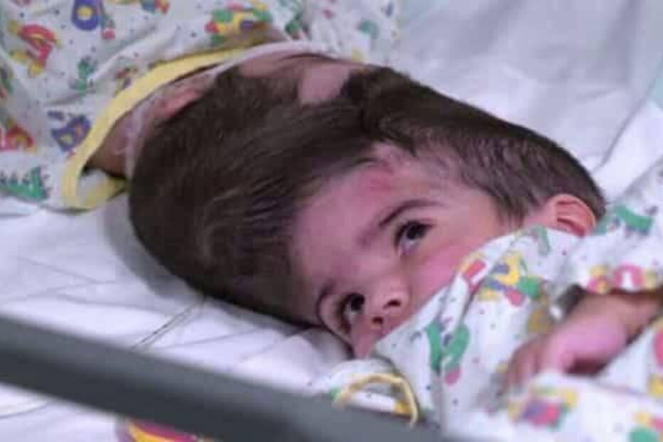 gémeas unidas pela cabeça