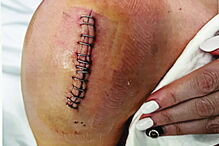 Carla Angelina teve de ser sujeita a duas intervenções cirúrgicas – uma na  testa e outra no ombro direito – na sequência  das agressões de que foi alvo  no interior da farmácia em  fevereiro. Sobreviveu graças à ajuda de uma funcionária 