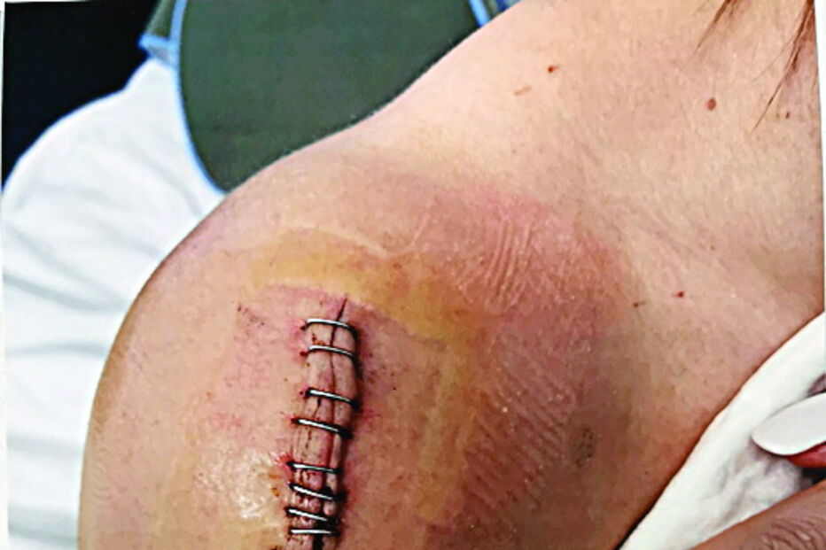 Carla Angelina teve de ser sujeita a duas intervenções cirúrgicas – uma na  testa e outra no ombro direito – na sequência  das agressões de que foi alvo  no interior da farmácia em  fevereiro. Sobreviveu graças à ajuda de uma funcionária 