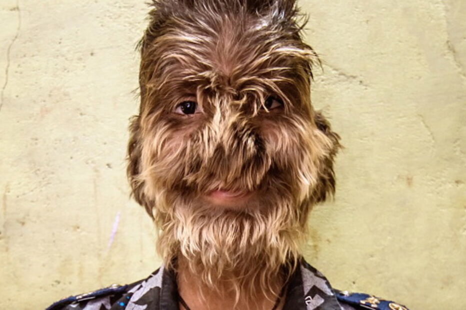 Lalit Patidar, tem 13 anos e sofre com síndrome do lobisomem 