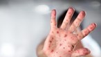 Direção-Geral da Saúde deteta dois novos casos de sarampo na região Centro