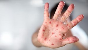 Portugal totaliza desde janeiro 30 casos de sarampo