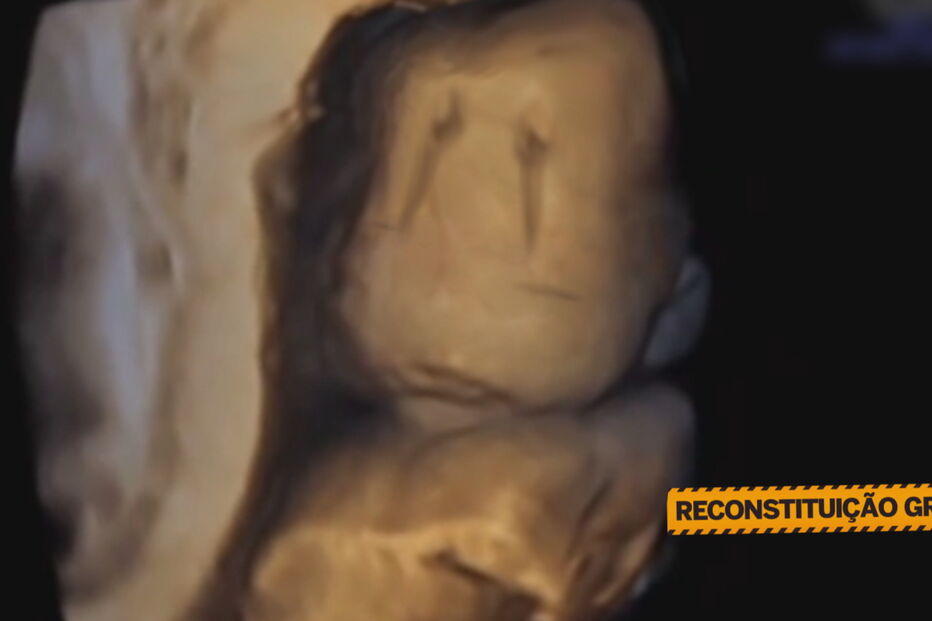 Bebé luta pela vida: nasceu sem olhos, nariz e sem parte do crânio