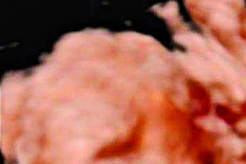 Ecografia de 'bebé sem rosto'