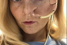 Mulher descobre síndrome que a impede de comer até ao fim da sua vida