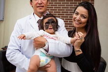 Luna, a menina que nasceu com uma marca na cara que faz lembrar o Batman