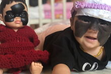 Luna, a menina que nasceu com uma marca na cara que faz lembrar o Batman
