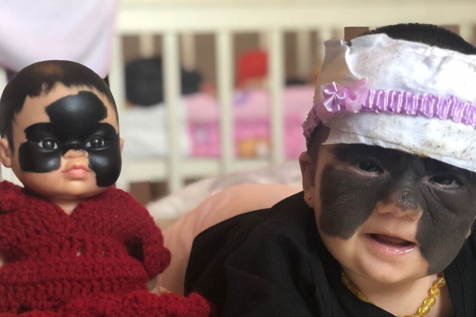 Luna, a menina que nasceu com uma marca na cara que faz lembrar o Batman