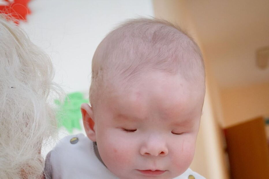 Bebé órfão que nasceu sem olhos foi adotado