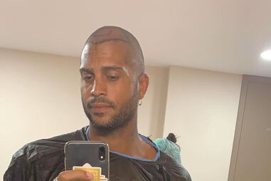 Guillaume Lalung decide recorrer a implantes capilares