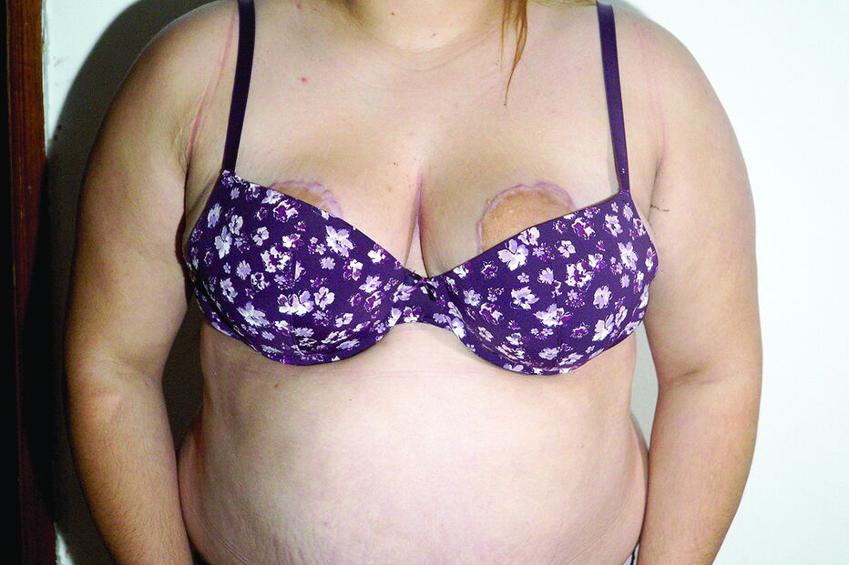 Jovem não consegue usar um sutiã que tape as aréolas 