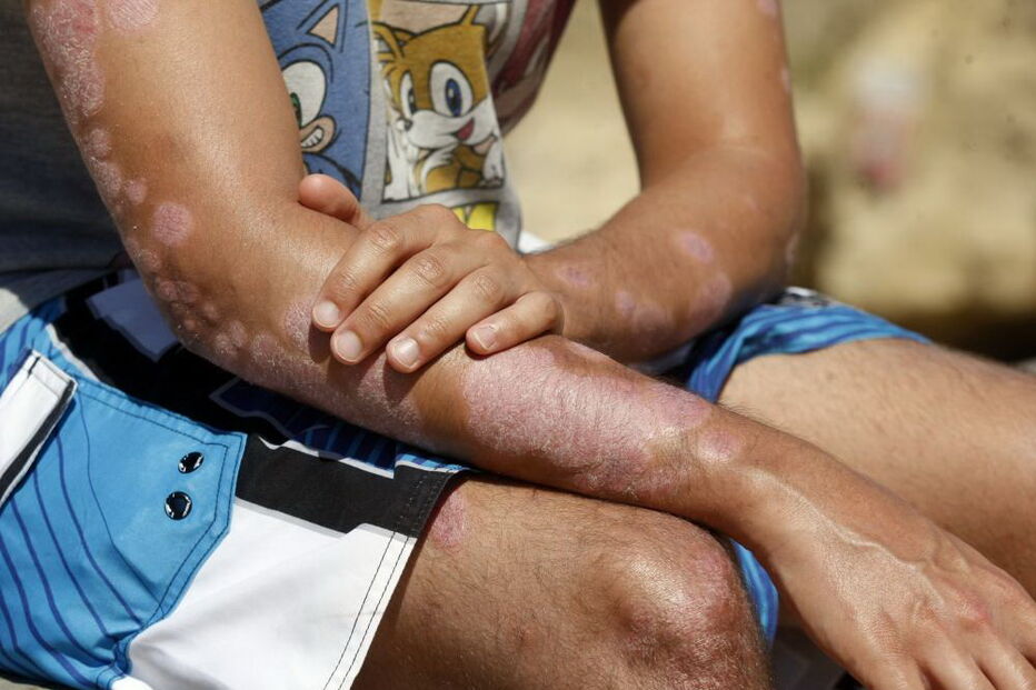 2020-01-09_11_43_27 psoriase.jpg