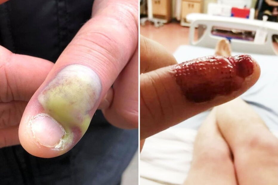Homem é operado de urgência depois de contrair infecção por roer as unhas
