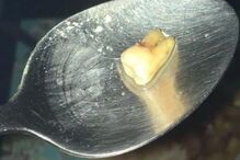 Restaurante chinês serve refeição com dente humano e mantém boa classificação de higiene