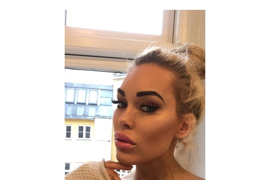 Mulher gasta quase 60 mil euros em cirurgia facial para se parecer com filtros do Snapchat