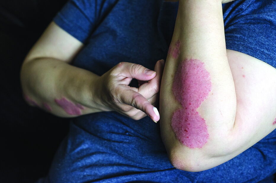 A psoríase tem um impacto importante na qualidade de vida dos doentes, sobretudo nas relações interpessoais 