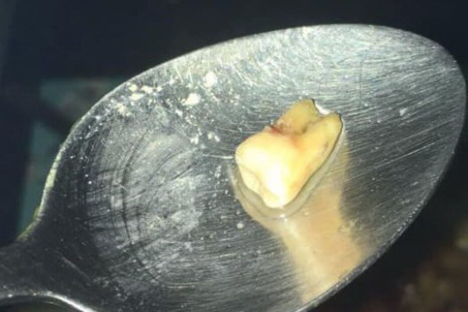 Restaurante chinês serve refeição com dente humano e mantém boa classificação de higiene